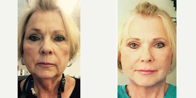 Facelift before and after photo