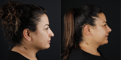 Rhinoplasty before and after photo