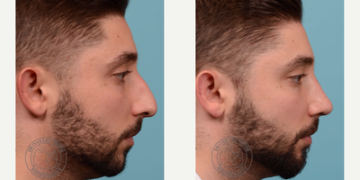 Septoplasty before and after photo