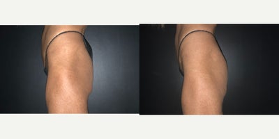 CoolTone before and after photo