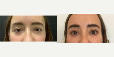 Eyelid Surgery before and after photo