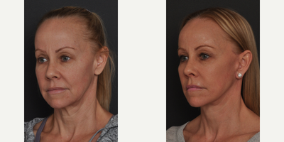 Facelift before and after photo
