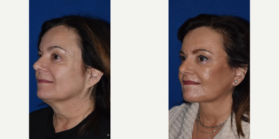 Neck Lift before and after photo