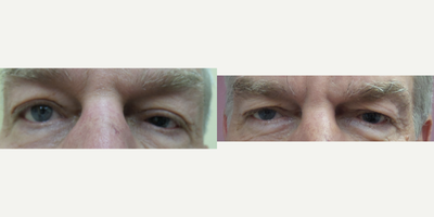 Ptosis Surgery before and after photo