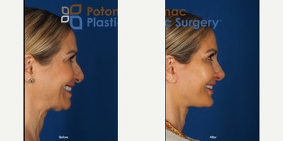 Rhinoplasty before and after photo