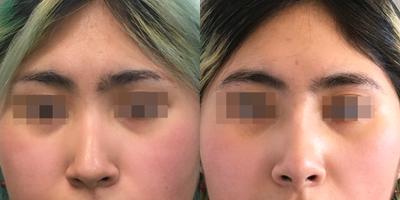 Asian Rhinoplasty before and after photo