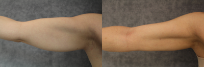 BodyTite before and after photo