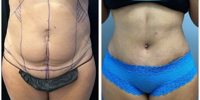 Drainless Tummy Tuck before and after photo
