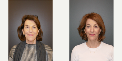 Facelift before and after photo