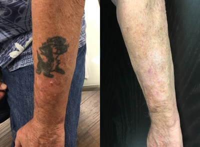 Tattoo Removal before and after photo