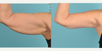 Arm Lift before and after photo