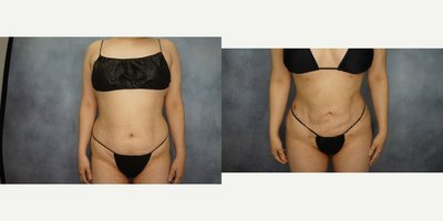 Brazilian Butt Lift before and after photo