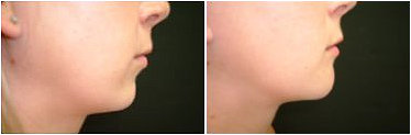 Chin Implant before and after photo