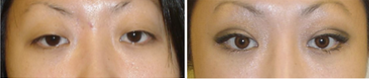 Double Eyelid Surgery before and after photo