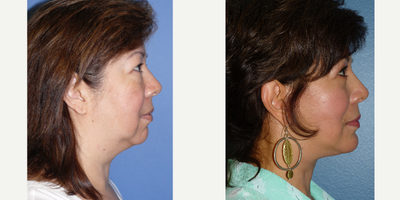 Facelift before and after photo