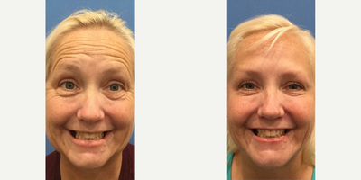Botox before and after photo