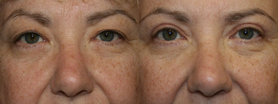 Eyelid Surgery before and after photo