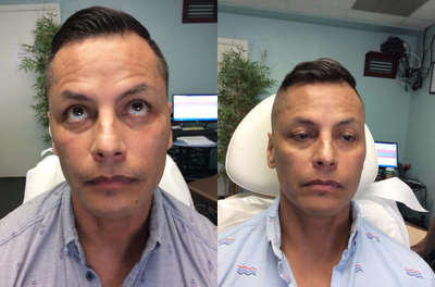 Eyelid Surgery before and after photo