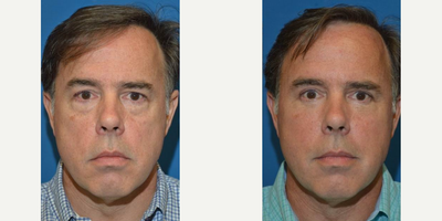 Eyelid Surgery before and after photo