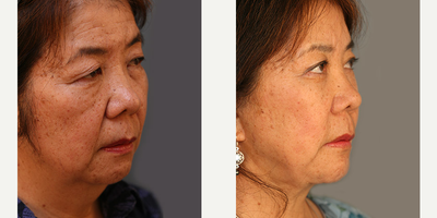 Facelift before and after photo