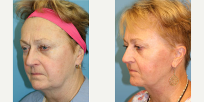 Facelift before and after photo