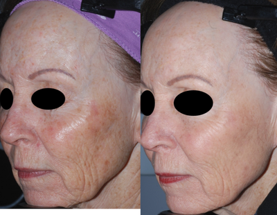 Laser Resurfacing before and after photo