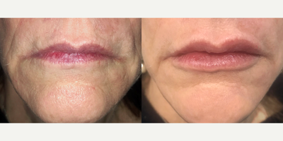 Restylane before and after photo
