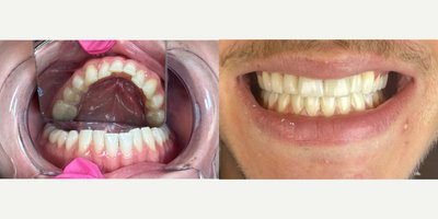 Clear Braces before and after photo