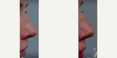 Dermal Fillers before and after photo