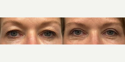 Eyelid Surgery before and after photo