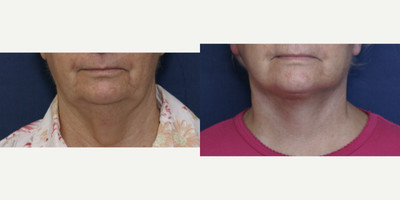Facelift before and after photo