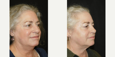 Juvederm before and after photo