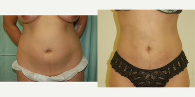 Liposuction before and after photo