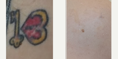 PicoWay before and after photo