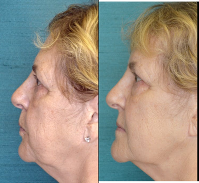 Restylane Lyft before and after photo