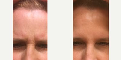 Botox before and after photo