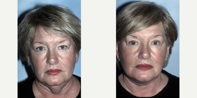 Facelift before and after photo
