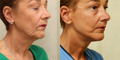 Facelift before and after photo