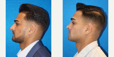 Rhinoplasty before and after photo