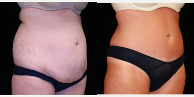 Tummy Tuck before and after photo
