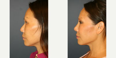 Asian Rhinoplasty before and after photo