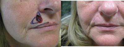 Mohs Surgery before and after photo