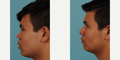 Revision Rhinoplasty before and after photo