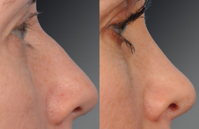 Rhinoplasty before and after photo