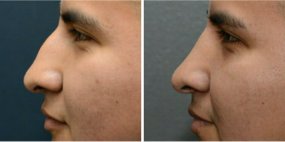 Rhinoplasty before and after photo