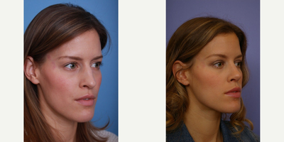 Rhinoplasty before and after photo