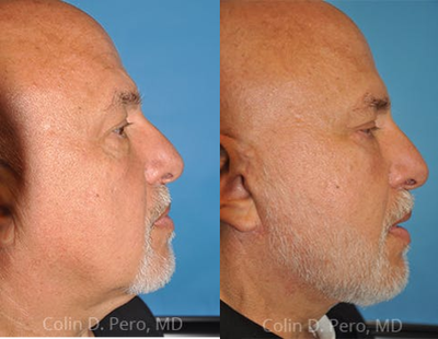 Facial Fat Transfer before and after photo