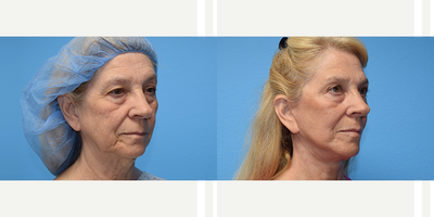 Lower Facelift before and after photo
