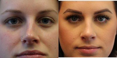 Rhinoplasty before and after photo
