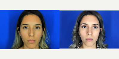 Rhinoplasty before and after photo